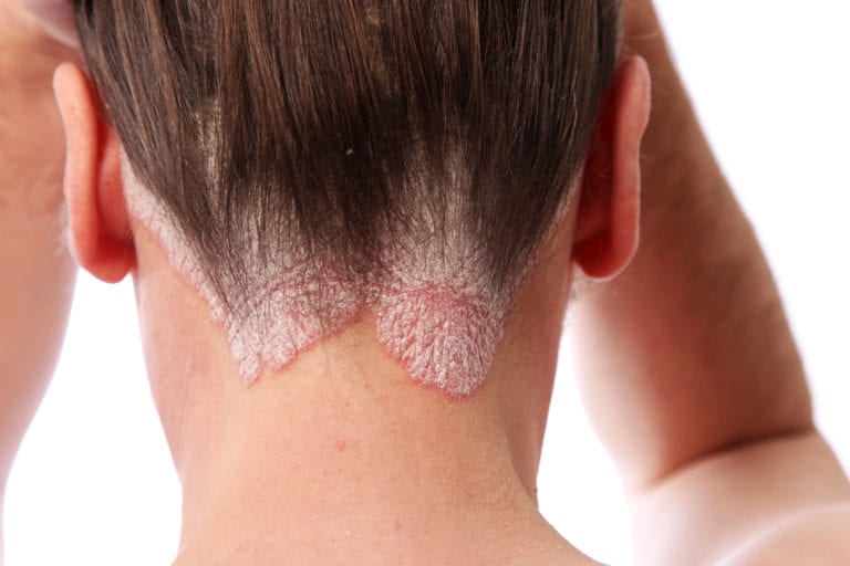 Psoriasis, una enfermedad en la piel que puede generar otros problemas