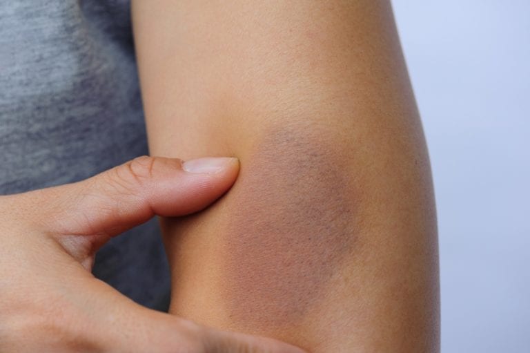 La hemofilia a pesar de no ser curable, se puede vivir con ella