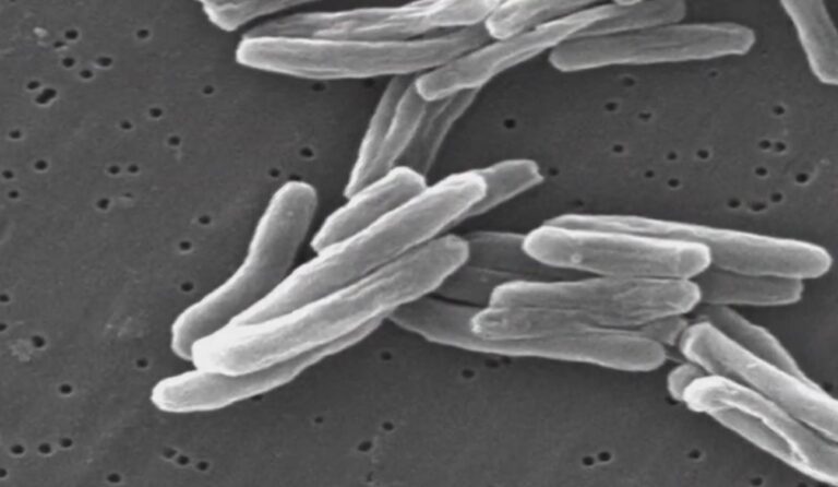 Aumenta la propagación de la tuberculosis en el mundo, alerta la OMS