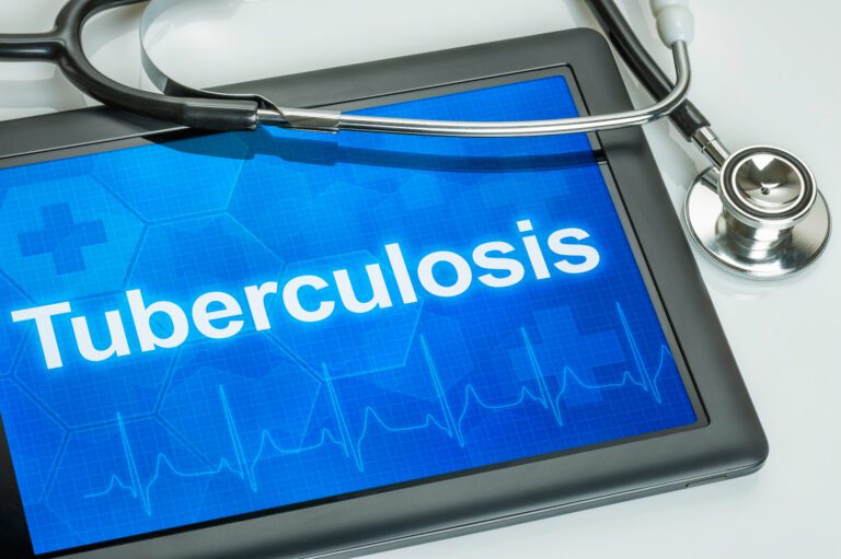 Incrementa en Tabasco el número de pacientes con Tuberculosis