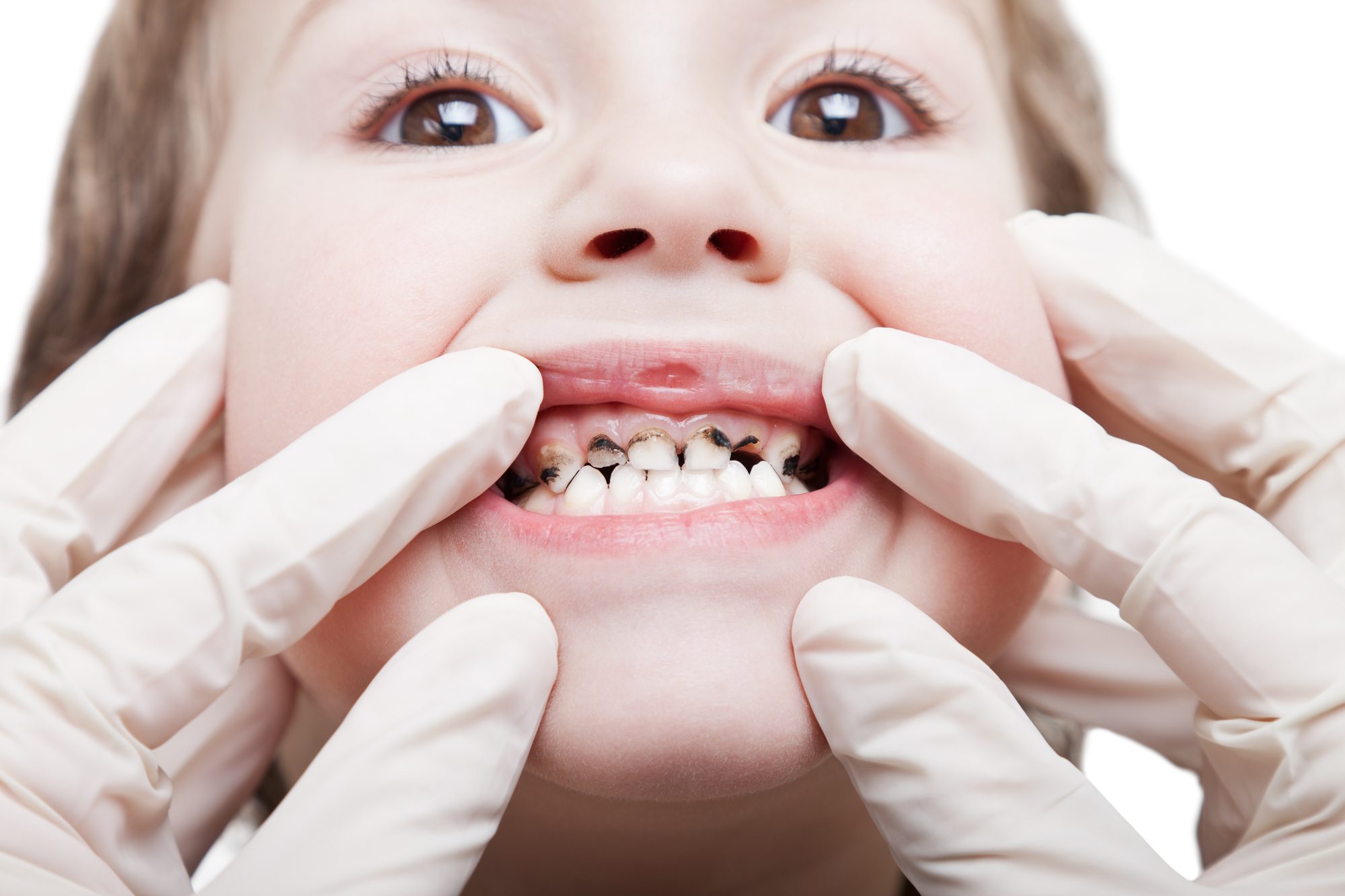 Dientes Chuecos Y Las Caries Se Pueden Prevenir - 88.9 Noticias