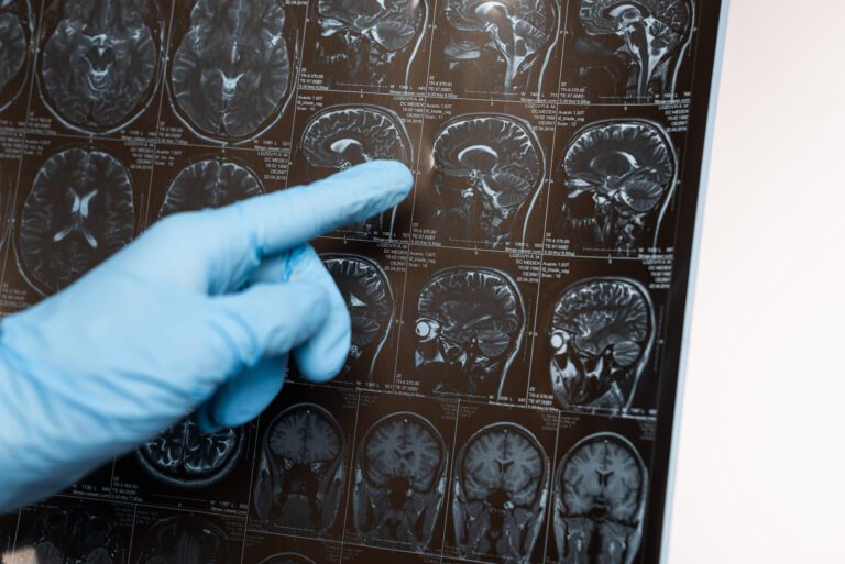 Estudio determina que hay una relación entre las lesiones cerebrales y la demencia 