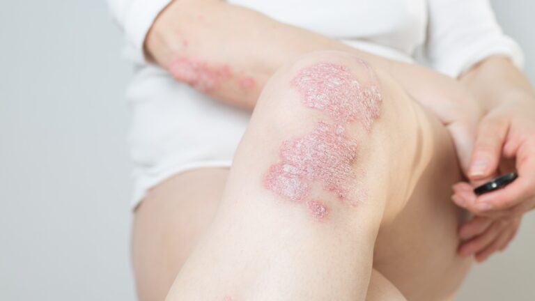 Especialistas llaman a erradicar estigmas sobre la psoriasis en México: una enfermedad que va más allá de la piel