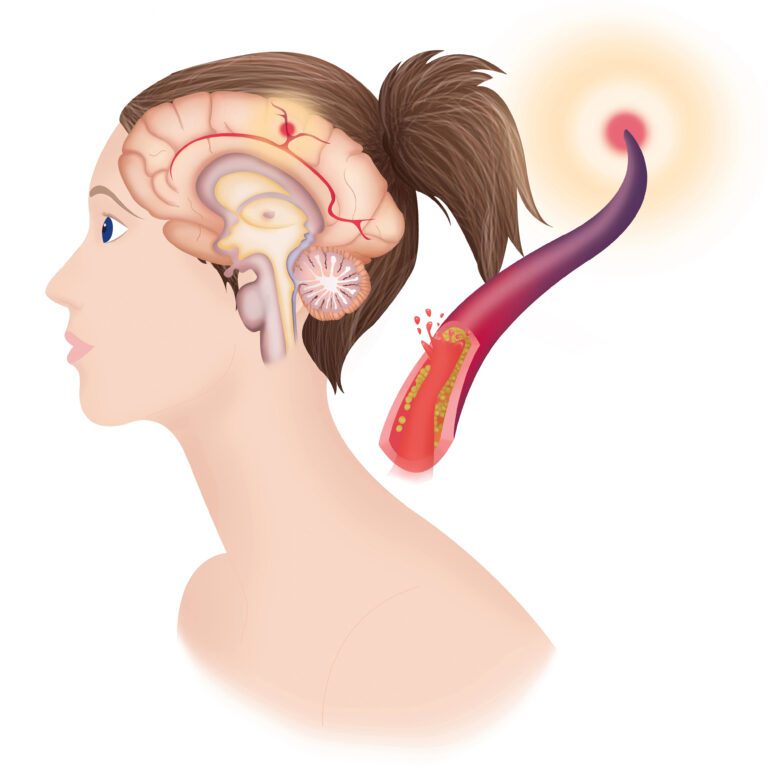Una de cada cuatro personas sufrirá un infarto cerebral en su vida