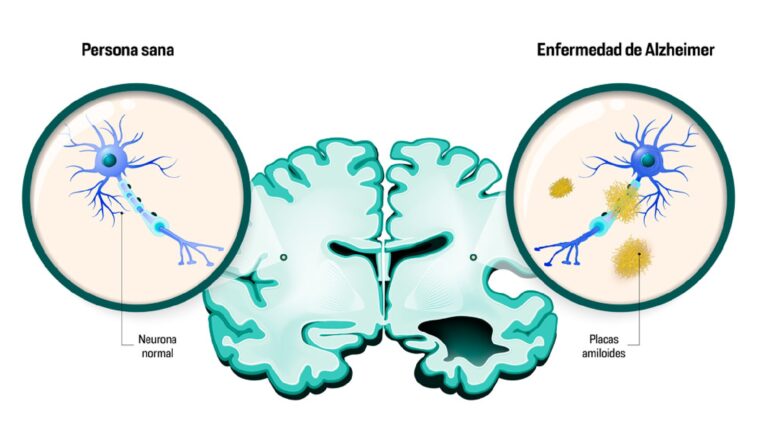 Estilo de vida saludable reduce el riesgo de Alzheimer: especialistas llaman a detectar señales tempranas