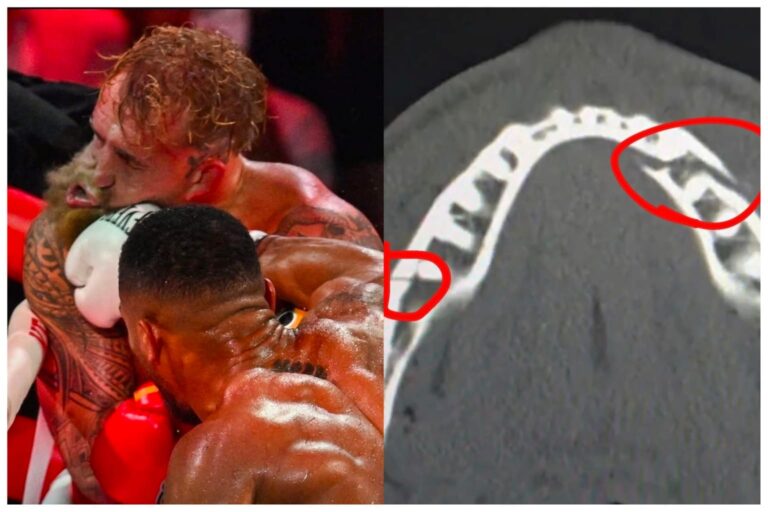 JAKE PAUL FRACTURA DE MANDIBULA FOTO: ESPECIAL